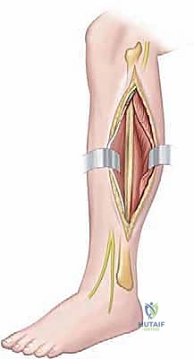 صورة توضيحية لـ بضع اللفافة لعلاج متلازمة الحيز الجهدي المزمنة: دليل شامل للمرضى مع الأستاذ الدكتور محمد هطيف
