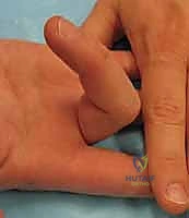 تقنيات خياطة الأوتار