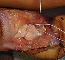 صورة توضيحية لـ إصلاح أوتار اليد القابضة في المنطقة الثانية