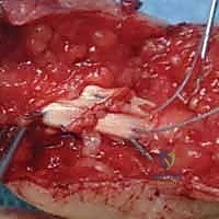 استخراج الأوتار المقطوعة