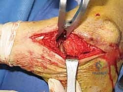 FIG 3 Radiographs of a 56-year-old diabetic woman with severe pes planovalgus deformity and gross subluxation of the subtalar and transverse tarsal joints radiographically