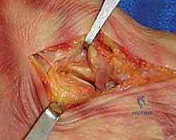 Single-Incision Medial Approach for Triple Arthrodesis
