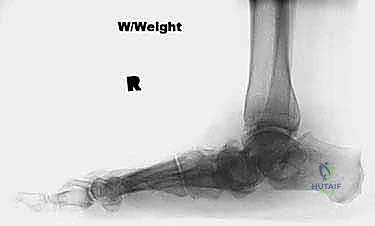 TECH FIG 1 The peroneus longus and brevis contractures are released through a small incision well above the level of the ankle joint to avoid wound complications