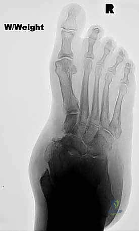 TECH FIG 1 The peroneus longus and brevis contractures are released through a small incision well above the level of the ankle joint to avoid wound complications