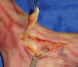 TECH FIG 2 The posterior tibial tendon is detached from its insertion on the navicular and excised to expose the underlying subtalar joint