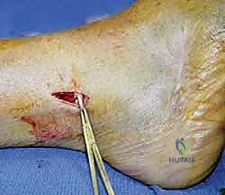 TECH FIG 1 The peroneus longus and brevis contractures are released through a small incision well above the level of the ankle joint to avoid wound complications