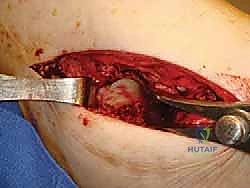TECH FIG 6 The calcaneocuboid joint is fixed percutaneously with a screw from distal to proximal