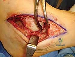 TECH FIG 6 The calcaneocuboid joint is fixed percutaneously with a screw from distal to proximal
