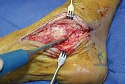 TECH FIG 4 With a lamina spreader between the talar neck and the calcaneus the middle and posterior facets of the subtalar joint are easily visualized