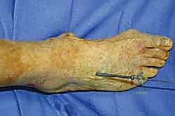 TECH FIG 6 The calcaneocuboid joint is fixed percutaneously with a screw from distal to proximal