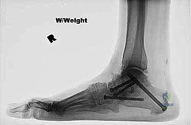 FIG 4 After single-medial-incision triple arthrodesis the patient shown in Figure 3 had excellent correction of her deformity without wound-healing complications