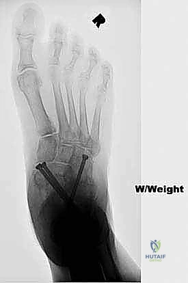 Surgical technique step for Single-Incision Medial Approach for Triple Arthrodesis