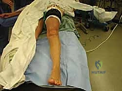 Mastering Cavovarus Foot Reconstruction: An Intraoperative Guide to Multiplanar Deformity Correction