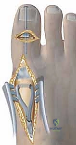 صورة توضيحية لـ القدم الجوفاء المعقدة كل ما تحتاج معرفته عن التشخيص والعلاج مع الأستاذ الدكتور محمد هطيف