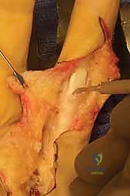Flexor Tendon Tenolysis: An Intraoperative Masterclass for Restoring Digital Function