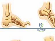 صورة توضيحية لتشوه القدم الجوفاء من المنظر الجانبي، تُظهر زيادة تقوس القدم