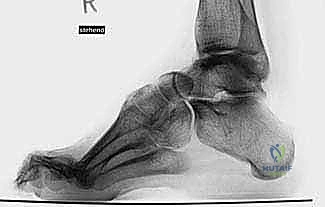 تقييم زوايا القدم في الأشعة السينية