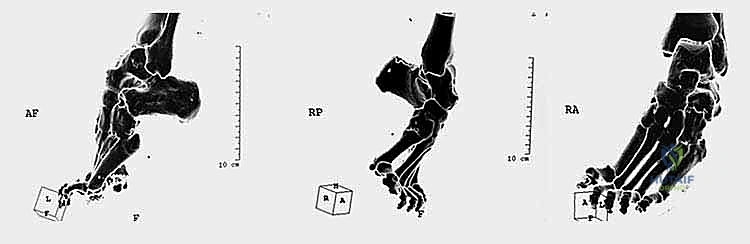 التشوه الناتج عن إصابات الأعصاب الطرفية