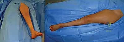 تقييم حركة الكاحل ووتر أخيل