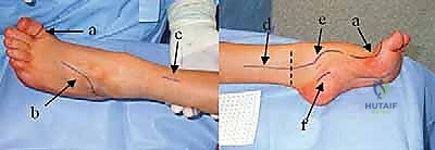 إجراء اختبار كولمان السريري