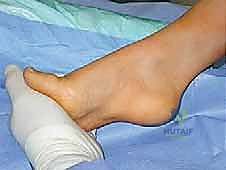 القدم الحنفاء الجوفاء الروحاء دليلك الشامل للعلاج مع الأستاذ الدكتور محمد هطيف في صنعاء