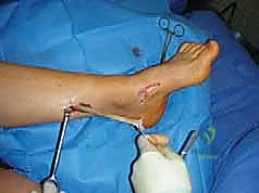 صورة طبية: القدم الحنفاء الجوفاء الروحاء دليلك الشامل للعلاج مع الأستاذ الدكتور محمد هطيف في صنعاء