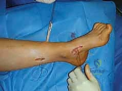 صورة طبية: القدم الحنفاء الجوفاء الروحاء دليلك الشامل للعلاج مع الأستاذ الدكتور محمد هطيف في صنعاء