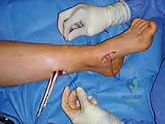 صورة توضيحية لـ القدم الحنفاء الجوفاء الروحاء دليلك الشامل للعلاج مع الأستاذ الدكتور محمد هطيف في صنعاء