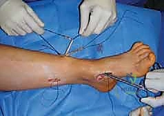 صورة طبية: القدم الحنفاء الجوفاء الروحاء دليلك الشامل للعلاج مع الأستاذ الدكتور محمد هطيف في صنعاء