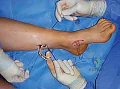 صورة طبية: القدم الحنفاء الجوفاء الروحاء دليلك الشامل للعلاج مع الأستاذ الدكتور محمد هطيف في صنعاء