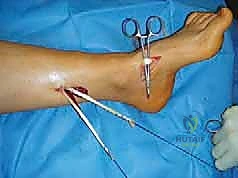 صورة طبية: القدم الحنفاء الجوفاء الروحاء دليلك الشامل للعلاج مع الأستاذ الدكتور محمد هطيف في صنعاء