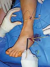 صورة طبية: القدم الحنفاء الجوفاء الروحاء دليلك الشامل للعلاج مع الأستاذ الدكتور محمد هطيف في صنعاء