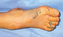 صورة توضيحية لـ القدم الحنفاء الجوفاء الروحاء دليلك الشامل للعلاج مع الأستاذ الدكتور محمد هطيف في صنعاء