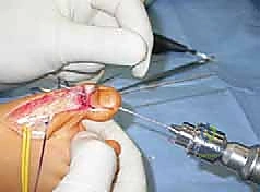 صورة طبية: القدم الحنفاء الجوفاء الروحاء دليلك الشامل للعلاج مع الأستاذ الدكتور محمد هطيف في صنعاء