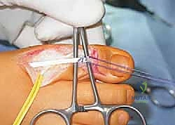 صورة طبية: القدم الحنفاء الجوفاء الروحاء دليلك الشامل للعلاج مع الأستاذ الدكتور محمد هطيف في صنعاء