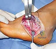 صورة توضيحية لـ القدم الحنفاء الجوفاء الروحاء دليلك الشامل للعلاج مع الأستاذ الدكتور محمد هطيف في صنعاء