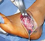 صورة طبية: القدم الحنفاء الجوفاء الروحاء دليلك الشامل للعلاج مع الأستاذ الدكتور محمد هطيف في صنعاء