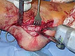 صورة طبية: القدم الحنفاء الجوفاء الروحاء دليلك الشامل للعلاج مع الأستاذ الدكتور محمد هطيف في صنعاء