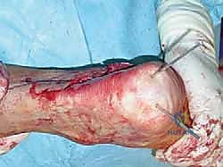 صورة طبية: القدم الحنفاء الجوفاء الروحاء دليلك الشامل للعلاج مع الأستاذ الدكتور محمد هطيف في صنعاء