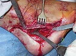 صورة طبية: القدم الحنفاء الجوفاء الروحاء دليلك الشامل للعلاج مع الأستاذ الدكتور محمد هطيف في صنعاء