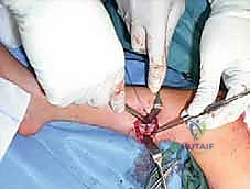 صورة طبية: القدم الحنفاء الجوفاء الروحاء دليلك الشامل للعلاج مع الأستاذ الدكتور محمد هطيف في صنعاء