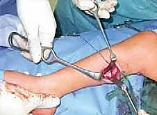 صورة طبية: القدم الحنفاء الجوفاء الروحاء دليلك الشامل للعلاج مع الأستاذ الدكتور محمد هطيف في صنعاء