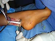 صورة طبية: القدم الحنفاء الجوفاء الروحاء دليلك الشامل للعلاج مع الأستاذ الدكتور محمد هطيف في صنعاء