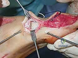 صورة طبية: القدم الحنفاء الجوفاء الروحاء دليلك الشامل للعلاج مع الأستاذ الدكتور محمد هطيف في صنعاء