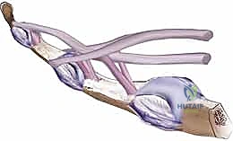صورة توضح الالتصاقات الشديدة وفشل الإصلاح الأولي