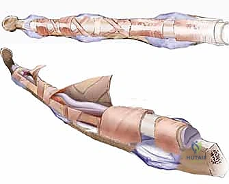 الشق الجراحي المتعرج للوصول للأوتار