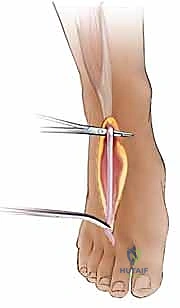 إعادة بناء أوتار الأصابع المرنة على مرحلتين: دليل شامل لاستعادة وظيفة اليد