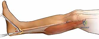 تكون الغمد الكاذب الناعم حول قضيب السيليكون