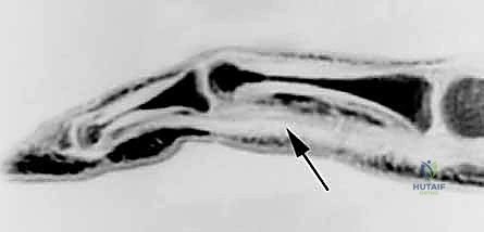 نظام البكرات المعقد في الأصابع