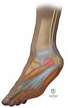 صورة توضيحية لـ علاج متلازمة النفق الرسغي واللفافة الأخمصية معًا: خبرة الأستاذ الدكتور محمد هطيف في صنعاء